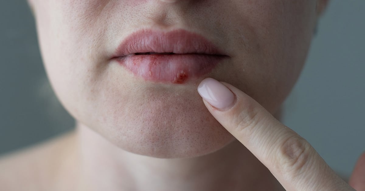 Un antiviral oral inédito para el herpes que no responde a los tratamientos clásicos